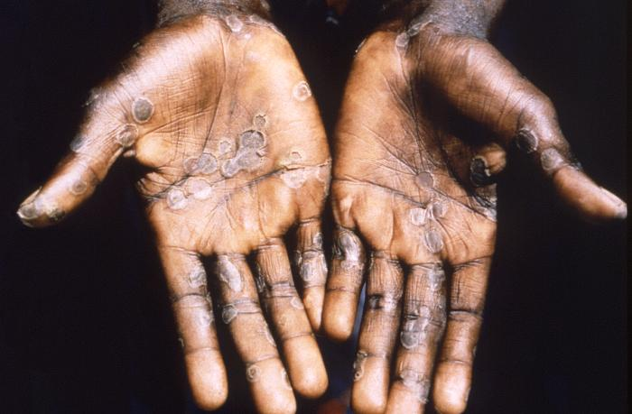 Foto mostra a palma da mão de uma pessoa infectada por Mpox. Há diversas erupções cutâneas.