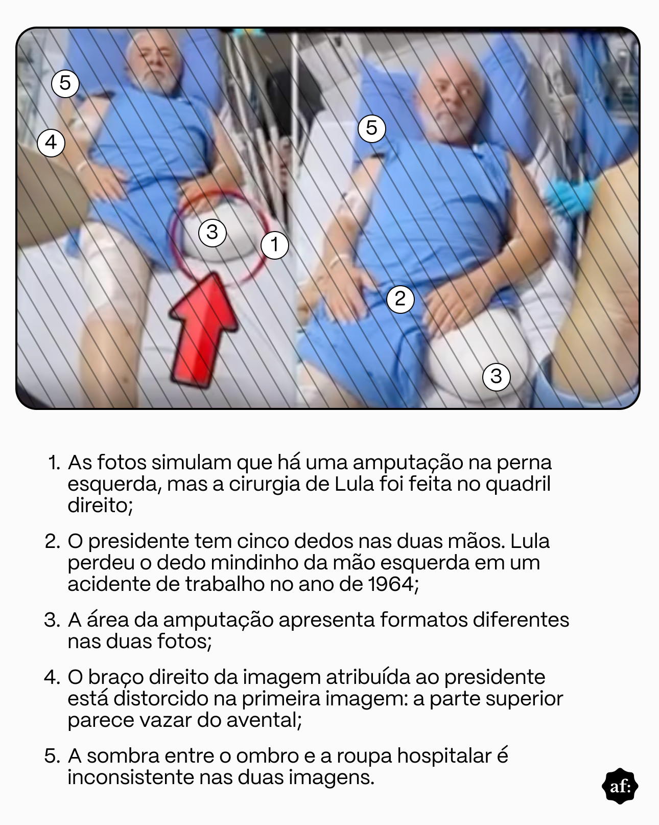 Infográfico de verificação de fatos composto por uma imagem na parte superior e uma lista numerada explicativa na parte inferior.  Na parte superior, há duas fotos lado a lado do presidente Luiz Inácio Lula da Silva deitado em um leito hospitalar vestindo avental azul, cobertas por hachuras diagonais. Círculos numéricos (de 1 a 5) indicam inconsistências visuais nas fotos. Na foto da esquerda, um círculo vermelho com uma seta indica o local de uma suposta amputação.  A parte inferior apresenta a lista com as explicações numeradas:  As fotos simulam que há uma amputação na perna esquerda, mas a cirurgia de Lula foi feita no quadril direito;  O presidente tem cinco dedos nas duas mãos. Lula perdeu o dedo mindinho da mão esquerda em um acidente de trabalho no ano de 1964;  A área da amputação apresenta formatos diferentes nas duas fotos;  O braço direito da imagem atribuída ao presidente está distorcido na primeira imagem: a parte superior parece vazar do avental;  A sombra entre o ombro e a roupa hospitalar é inconsistente nas duas imagens.  No canto inferior direito, há o logo do Aos Fatos.