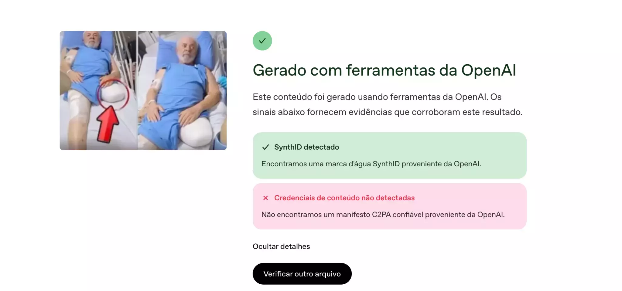 Captura de tela da interface de uma ferramenta de verificação de mídia digital. À esquerda, há duas imagens do presidente Luiz Inácio Lula da Silva deitado em uma cama de hospital, vestindo avental azul, com a perna esquerda aparentemente amputada e com ataduras; um círculo e uma seta vermelhos apontam para a amputação. À direita, o painel exibe o título 