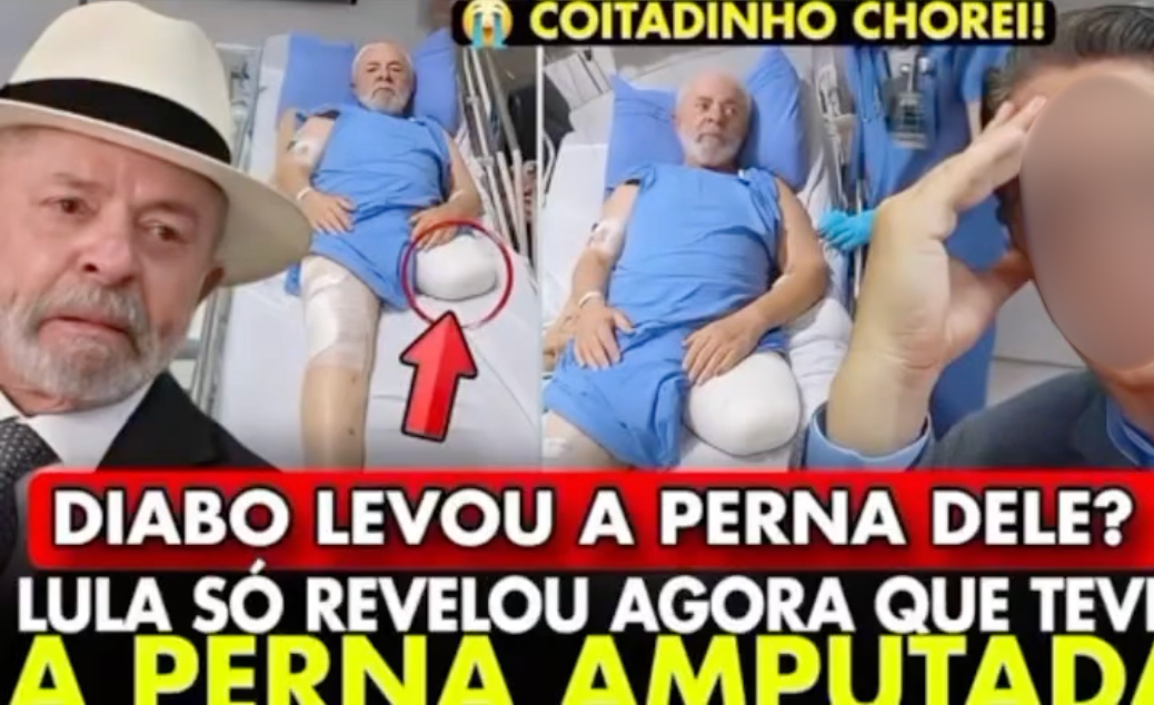 Uma imagem gerada por inteligência artificial mostra o presidente Luiz Inácio Lula da Silva deitado de costas em um leito hospitalar. Ele veste um avental cirúrgico azul e tem a perna esquerda amputada acima do joelho, com o coto enrolado em ataduras brancas. Na imagem da esquerda, há um círculo vermelho destacando o coto da perna amputada e uma seta vermelha apontando para ele. A perna direita também aparece parcialmente enfaixada. Ao fundo, vê-se um profissional de saúde com luvas azuis. Ao redor, há montagens de Lula usando chapéu e expressão triste, um homem de óculos chocado, e textos chamativos em destaque vermelho e amarelo: ‘[emoji chorando] COITADINHO CHOREI!’ ‘DIABO LEVOU A PERNA DELE?’ e ‘LULA SÓ REVELOU AGORA QUE TEVE A PERNA AMPUTADA’