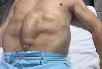 Foto não mostra barriga de Bolsonaro antes de cirurgia