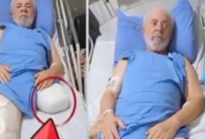 É falso que Lula disse que teve perna amputada em 2023